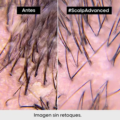 LOREAL PROFESSIONNEL Serie expert scalp advanced champú anticaspa con activos dermatológicos para cuero cabelludo con caspa 300 ml 